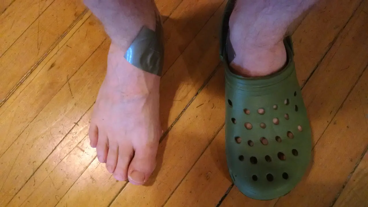 Blisters Are a Possible Result of Wearing Crocs.